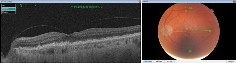 Ryc. 5. Skan obrazujący siatkówkę i naczyniówkę okolicy plamkowej oka lewego u 81-letniej pacjentki z dystrofią rogówki Fuchsa.