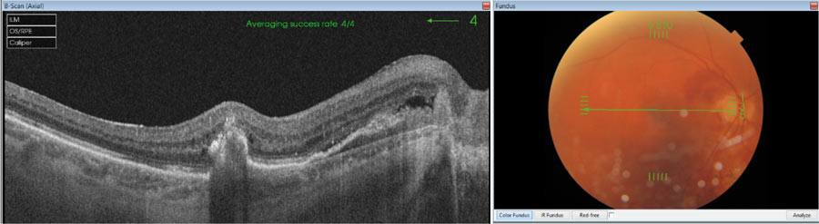 Ryc. 6. Skan obrazujący siatkówkę okolicy plamkowej oka prawego u 77-letniego pacjenta z rozpływem skrzącym ciała szklistego.