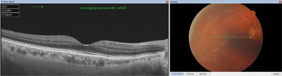 Ryc. 7. Skan obrazujący siatkówkę i naczyniówkę okolicy plamkowej oka prawego u 78-letniej pacjentki z zaćmą.