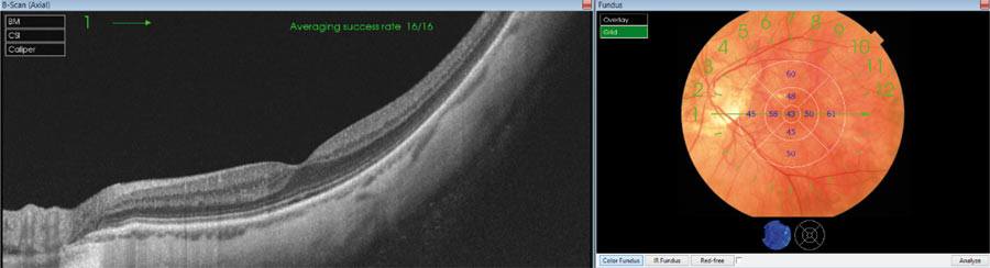 Ryc. 8. Skan obrazujący siatkówkę i ścieńczałą naczyniówkę okolicy plamkowej oka lewego u 29-letniej pacjentki z wysoką krótkowzrocznością (-22 D); na tle fotografii z dna oka widoczna jest mapa grubości naczyniówki