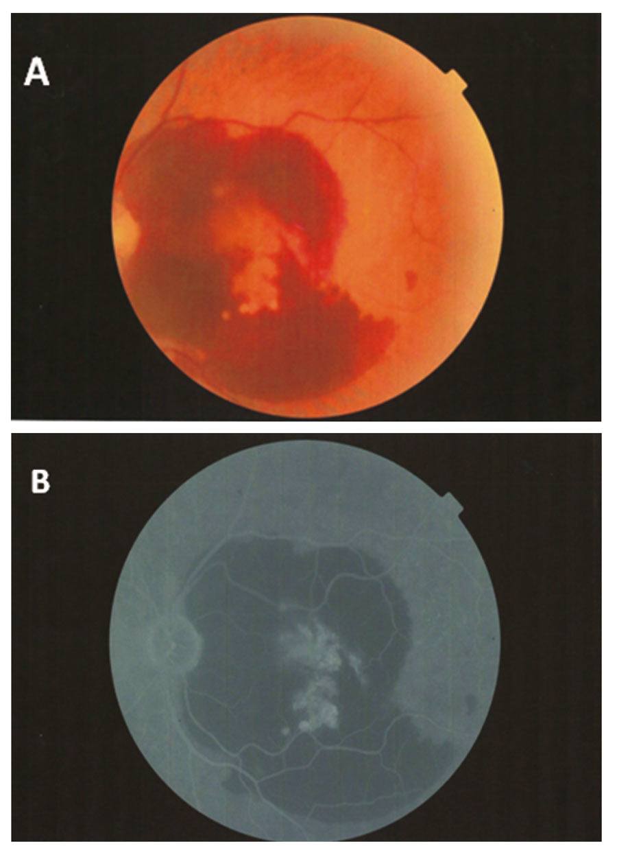  Rycina 3. Dominujący wylew krwi – kolorowe zdjęcie (A), angiografia fluoresceinowa (B).