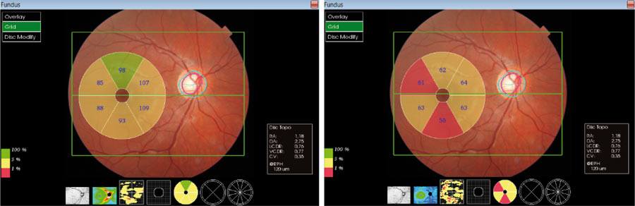 Ryc. 11. Analiza grubości GCC z RNFL-po lewej oraz bez RNFL ? po prawej w plamce oka prawego u 18-letniego pacjenta z poszerzonym zagłębieniem tarczy nerwu wzrokowego, prawidłową grubością RNFL wokół tarczy nerwu wzrokowego oraz dodatnim wywiadem rodzinnym w kierunku jaskry ? wynik graniczny (kolor żółty) i patologiczny (kolor czerwony).