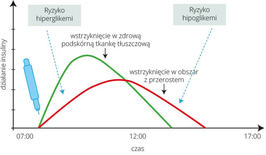 wykres-piatkiewicz