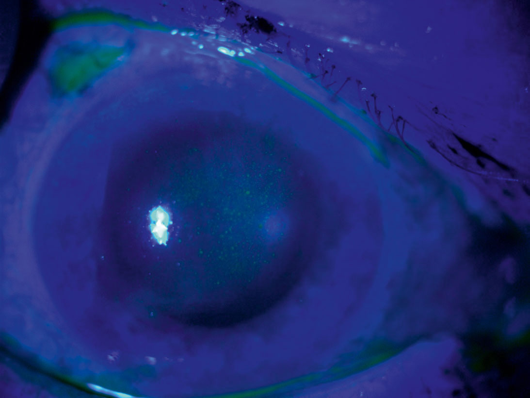 Zdjęcie 1. Powierzchowne rozlane barwienie nabłonka rogówki w zespole suchego oka