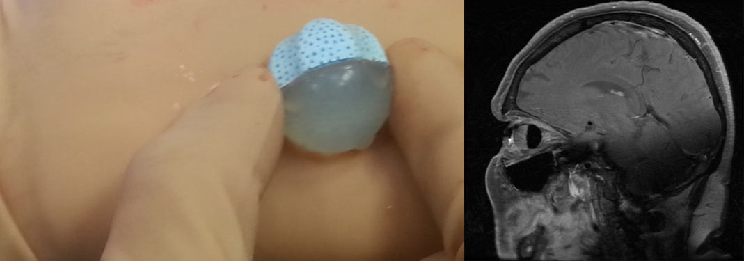 Ryc. 13. Implant oczodołowy Guthoffa przed wszyciem i prawidłowo umiejscowiony widoczny w badaniu MRI.