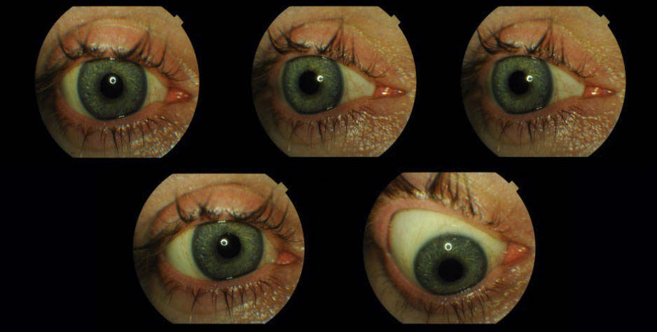 Ryc. 19. Ruchomość protezy oka umiejscowionej w oczodole z implantem oczodołowym.
