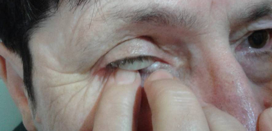 Ryc. 20. Ręczny sposób wyjmowania protezy oka.