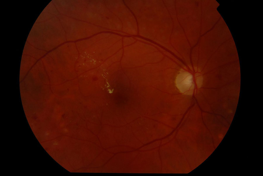 Ryc. 1. Kolorowe zdjęcie dna prawego oka – klinicznie znamienny obrzęk plamki (pierścień twardych przesięków w bezpośrednim sąsiedztwie dołka).