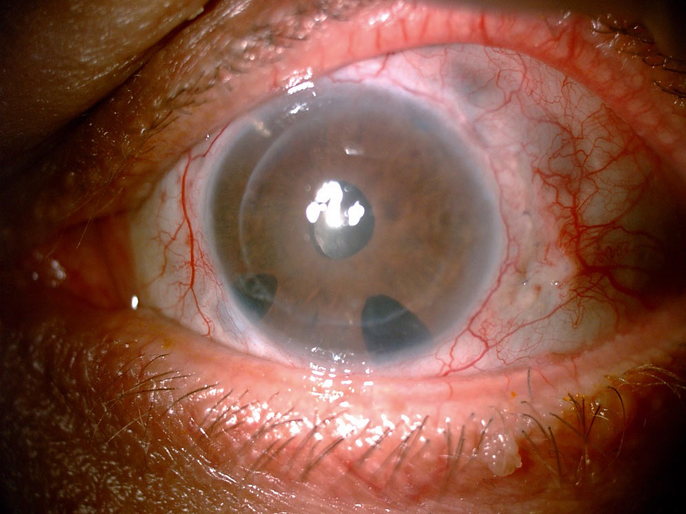 Fot.1. Oko po DSAEK z powodu keratopatii pęcherzowej, wcześniej po licznych operacjach przeciwjaskrowych z minisetonem Express oraz pseudofakią 