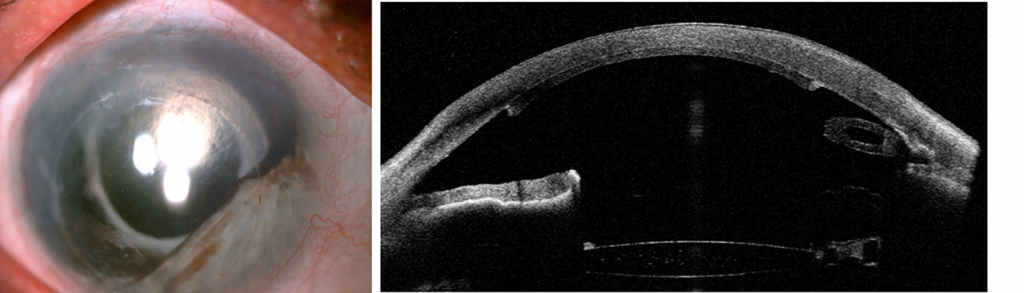 Fot.2. Oko po DSAEK z powodu keratopatii pęcherzowej, z częściową aniridią, obecnością zastawki Ahmeda oraz pseudofakią, a) widok z lampy szsczelinowej, b) przekrój horyzontalny w badaniu AS-OCT