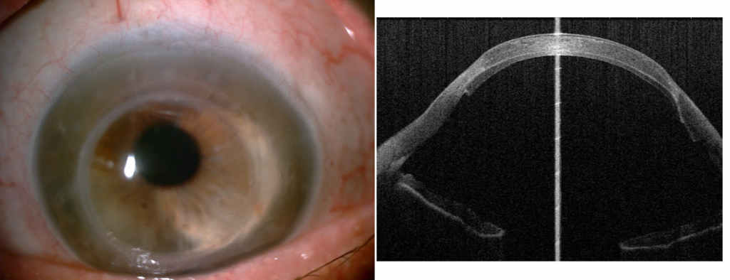 Fot. 3. Oko kilkanaście lat po przeszczepieniu drążącym z powodu stożka rogówki i 4 miesiące po DSAEK z powodu dekompensacji pierwszego przeszczepu: a) widok w lampie szczelinowej; b) obraz w badaniu AS-OCT